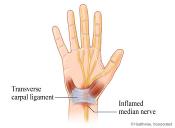 Internal view of Carpal Tunnel in Wrist